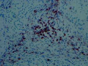 infiltration of tcells